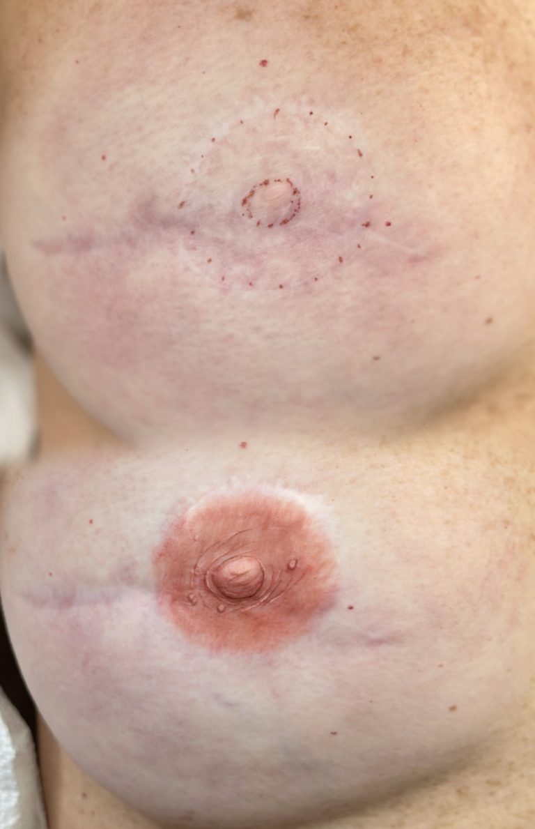 post-mastectomy-tattoo
